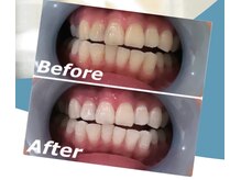 キャス(KYAS)/セルフホワイトニング設置店！