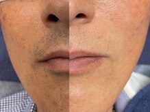 メンズオーシャンブルー/ヒゲ症例5