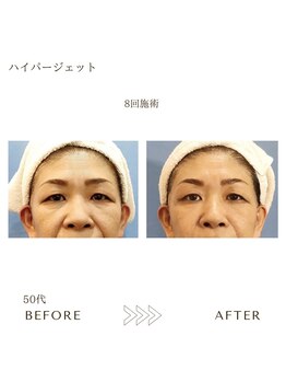 サロン エイトミー(salon 83)/ハイパージェット/before→after