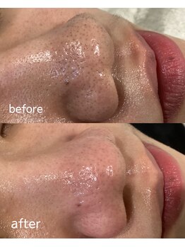 レアビューティー(Le'a beauty)/ハイドラ毛穴洗浄