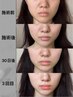 jrエステティシャン 小顔マシン大満足小顔頬+あご裏 3層ショット打ち放題