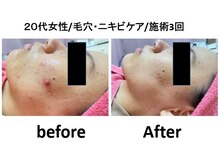 メディカルエステ アンボーテ/肌改善ケア