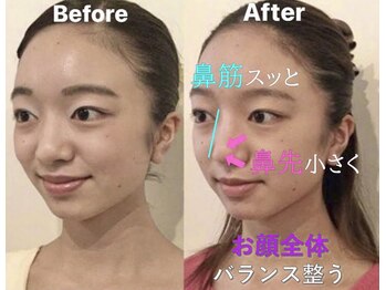 ラプリ 大宮店(Raplit)/隆鼻＋輪郭矯正40分10回