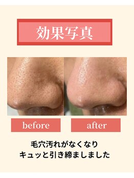 ナーズ(NAZ)/毛穴レス引き締めコース