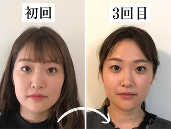 小顔矯正サロン セラフィ/骨格矯正3回目の効果は最高へ！