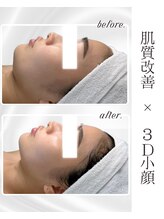 リアム(LiAm)/ララピール×レモンボトル