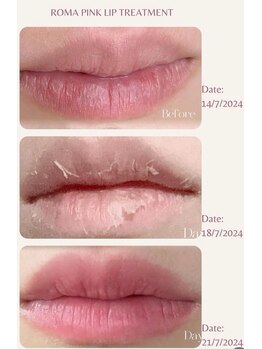 ヨウン 大阪心斎橋(yeoun)/ローマピンク大阪/メラニンケア