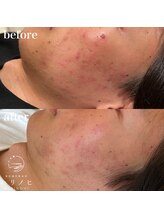 ハリノヒ 本町院/肌荒れ・ニキビケアメンズ美容鍼