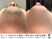 メンズ脱毛サロン ボス(BOSS)の雰囲気（最短期間で脱毛完了！！＃ヒゲ脱毛＃脱毛＃メンズ脱毛）
