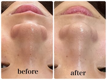 デューン 蕨店(Dune)/毛穴洗浄・ハーブピーリング