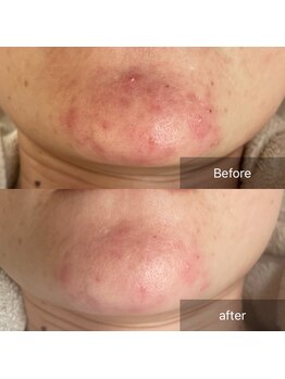 グレイス(Grace)/繰り返すニキビ