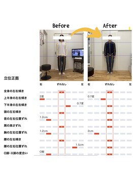 篠丸接骨院/◎施術実績◎O脚が真っ直ぐに!