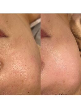 芦屋楓鍼灸院/毛穴引き締め、トーンアップ◎