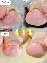 ニコワイズネイル(Nico Y's Nail)/【巻き爪緩和コース】