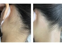 ラフォクシー(La.Foxy)/うなじWax脱毛