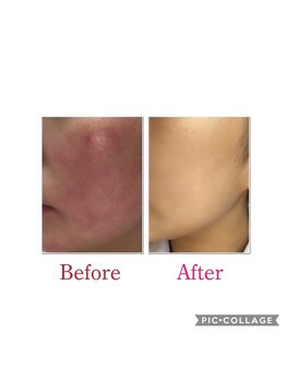 エクレクティック(ECLECTIC)/ハーブピーリング/小顔