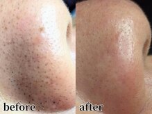 リーインカーナ アーティスト(REINCARNA ARTIST)/毛穴【エクストラクション】