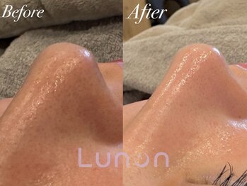 ルノン(Lunon)/毛穴洗浄ハイドロ