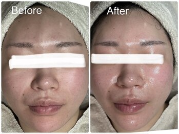 ルミネル 名古屋新栄(Luminelle)/水光ピーリング