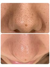 ハクビューティー(HAKU BEAUTY)/黒ずみ毛穴