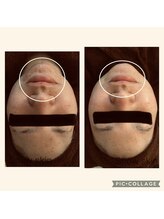 スノースキン(Snow skin)/【繰り返す頑固な顎ニキビ】