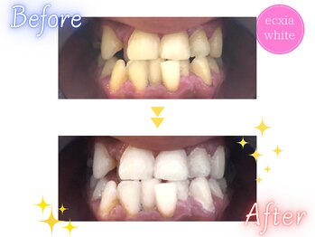 エクシアホワイトニング 天神店/ビフォーアフター　3か月後