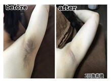 30代男性　【ワキ脱毛】　2回目施術後before→after