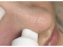 アイスリー(i III)/毛穴の汚れが浮き出る♪