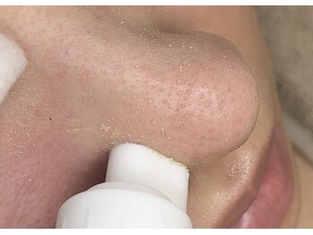 アイスリー(i III)/毛穴の汚れが浮き出る♪