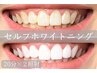 セルフホワイトニング