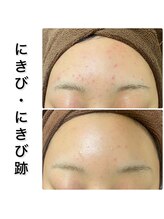 ビオプラス(BioPlus+)/ハーブピーリング/川崎