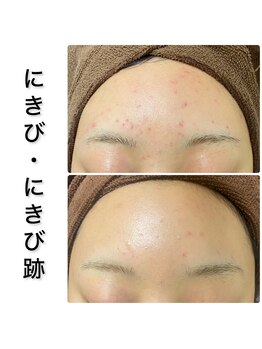 ビオプラス(BioPlus+)/ハーブピーリング/川崎