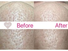 ベアール(beal)/毛穴特化ハーブピーリング