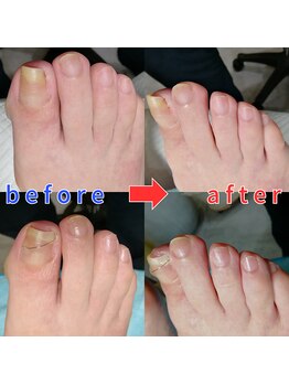 【巻き爪】ネイル/フット