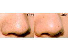 プライベートサロン 美月/イチゴ毛穴撃退！ツルツル肌へ