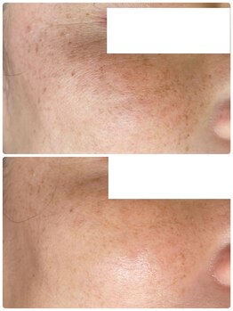 ティエラ(TIERRA)/シミケア2回