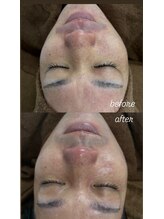 キュル(Kyul)/REVIハーブピーリング