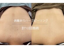 ヒジ(Life Salon)/ハーブピーリング