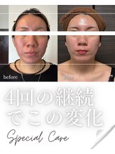 リノン(LIINON)/4回の継続でこの変化！