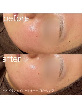 ルルラ リコ(lulula rico)/症例写真/ハーブピーリング