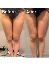 リレイスフクオカ(RelaceFUKUOKA)/脂肪分解