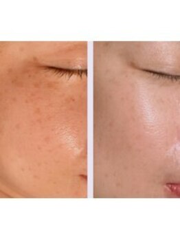 カルミア(kalmia)/【シミケア】レチノールピール