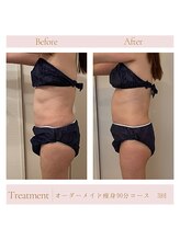 エミル(Emillu)/＊Body_ビフォーアフター