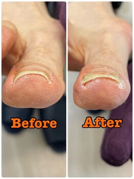 1度の施術で改善!