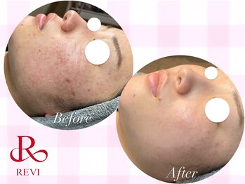 ラティーナ(Lattina)/陶肌トリートメント