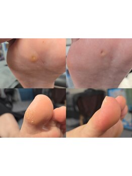 角質ケアができるサロン