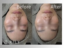 リリー(RILY)/【プラズマビフォーアフター】