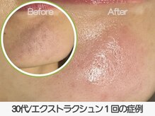 ラ コケット(La Coquette)/お顔全体の毛穴詰まり／ざらつき