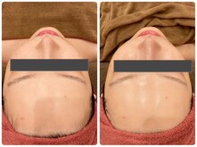 マリスレジーナ 新保店(MarisRegina)/ララピール　1回　BeforeAfter