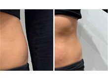 レナセール FUK 福岡店(RENACER FUK)/お腹とクビレ